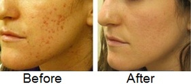 Before after acne scar surgery picture