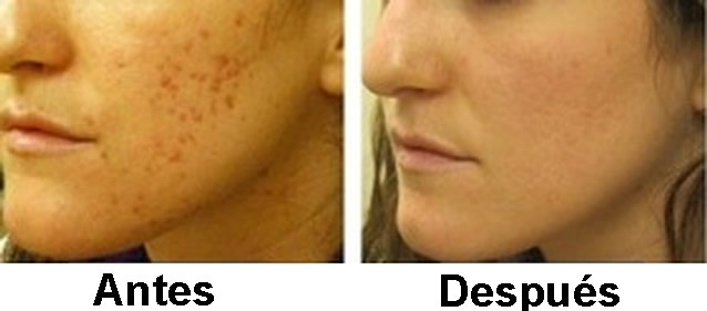 Imagen de antes y después de una cirugía para las cicatrices dejadas por el acné