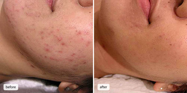 Imagen de antes y después del tratamiento de acné